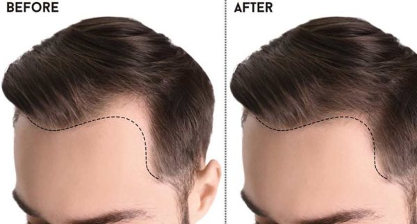 Chisel Hair Hair Transplant – Chisel Clinic